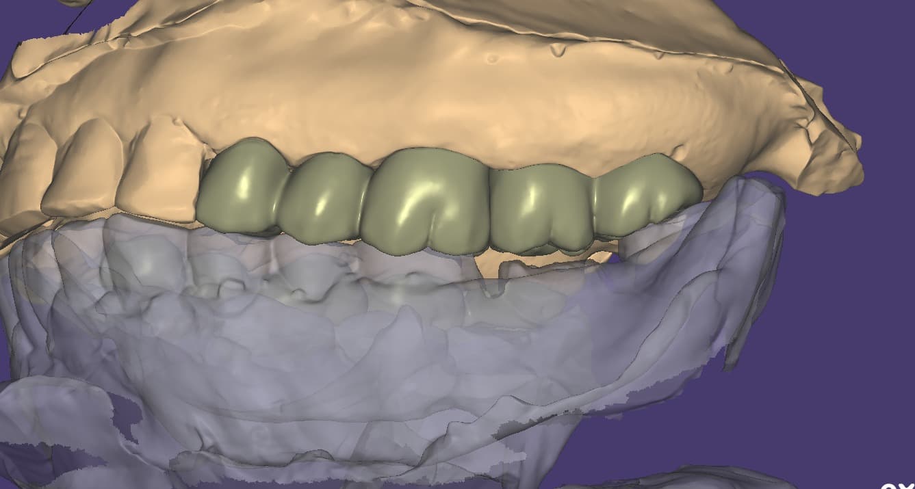 Anterior bridge design — dental restoration by Shanti Dental Lab