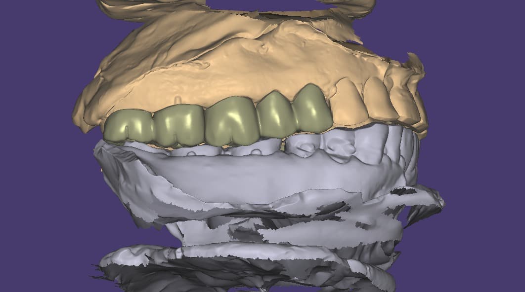 Anterior front view — dental restoration by Shanti Dental Lab