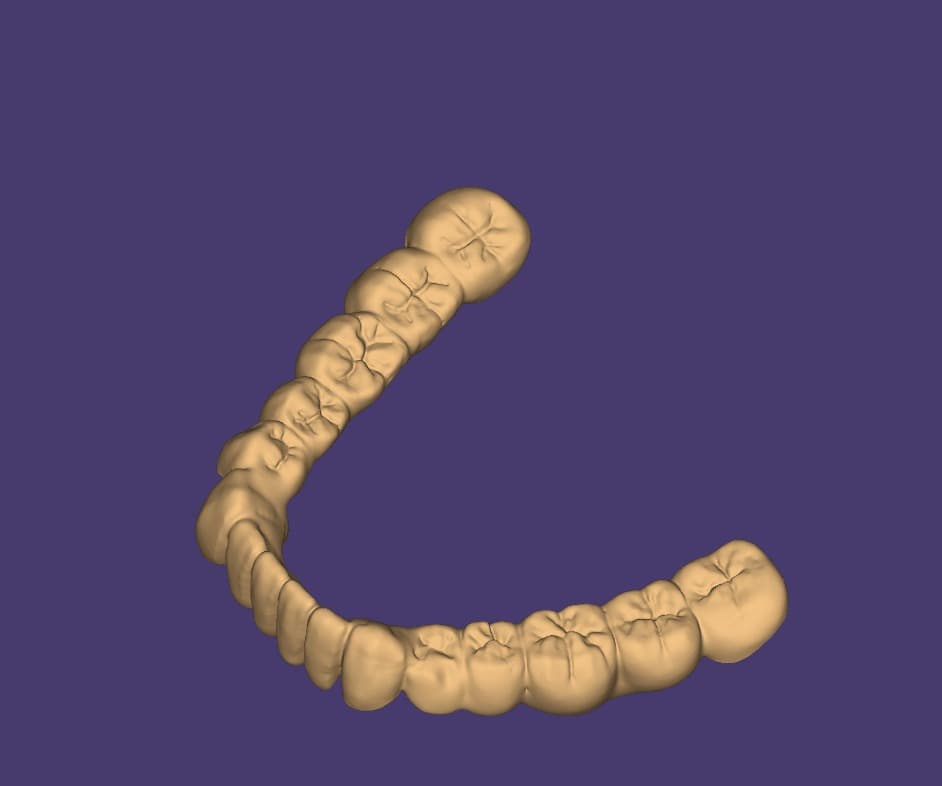 Full arch CAD design — dental restoration by Shanti Dental Lab
