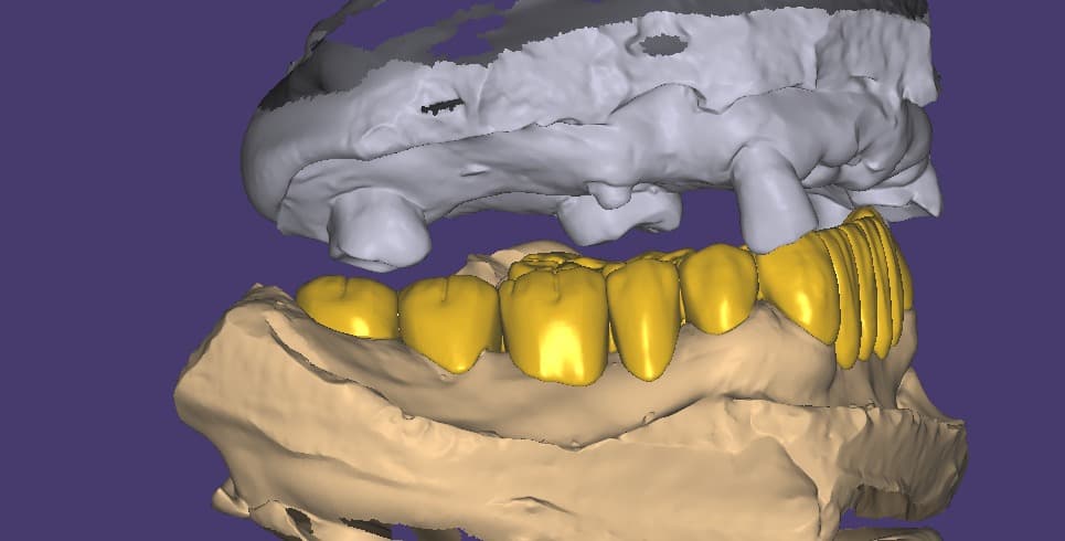 Crown & bridge gold — dental restoration by Shanti Dental Lab