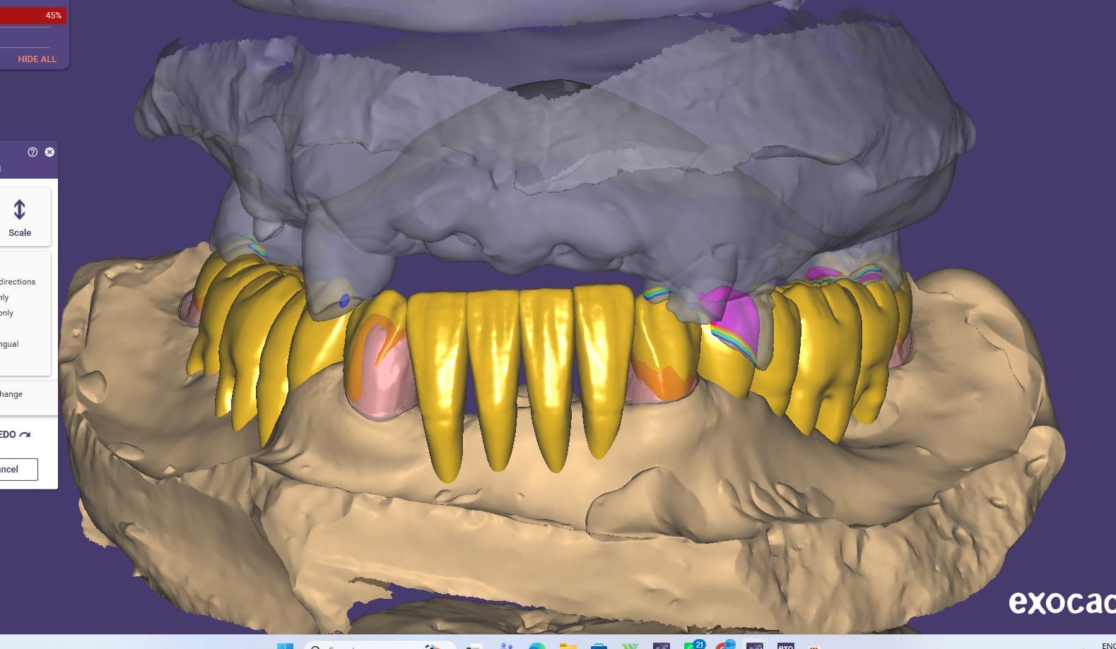 Implant bridge CAD — dental restoration by Shanti Dental Lab